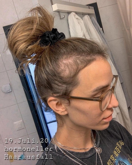 Six mois après la naissance de sa fille, l'influenceuse suisse Anja Zeidler a montré sa perte de cheveux et la repousse.
