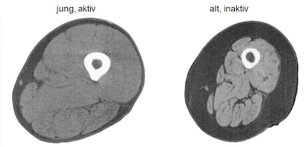 Images de résonance magnétique à travers le milieu de la cuisse d'un adulte sain de 25 ans (à gauche) et d'un adulte sain de 75 ans (à droite), montrant une sarcopénie. On remarque la masse musculaire plus faible (gris clair), la graisse sous-cutanée plus importante (gris foncé) et l'augmentation de la graisse intramusculaire (lignes gris foncé) dans la jambe du participant le plus âgé. Adapté de [32].
