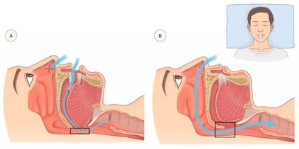 Le trajet et la quantité d’air respiré changent en comparant la respiration buccale (A) à la respiration nasale (B)