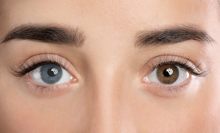 Un regard bicolore : La concentration de mélanine est plus importante dans l'œil brun.